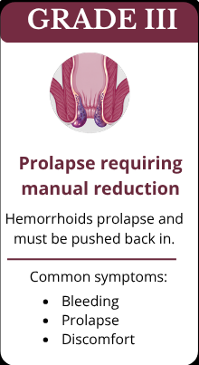 Grade-3-Hemorrhoids