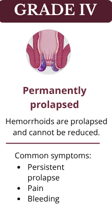 Grade-4-Hemorrhoids