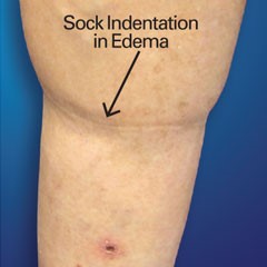 What Causes Swelling in the Legs