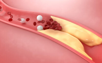 What Is Atherosclerosis?