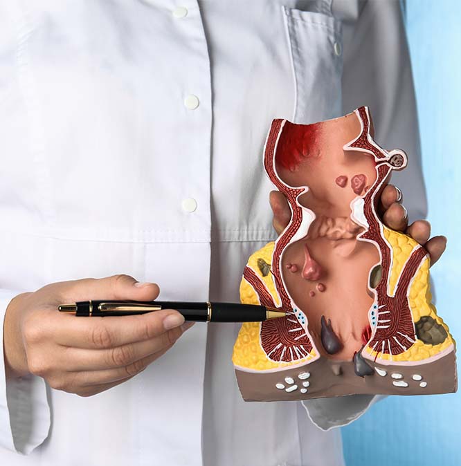 hemorrhoids procedure