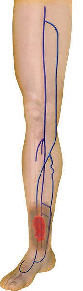 leg 1 (1) leg 1 (1)