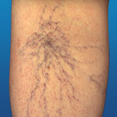 spider veins condition